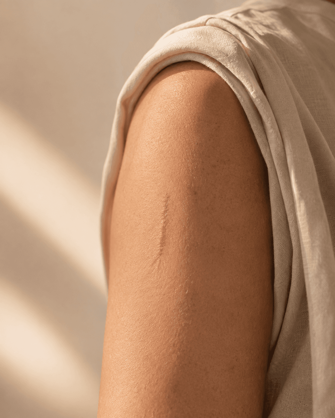 Close-up of a fully healed scar on a woman’s upper arm beside an ivory sleeve